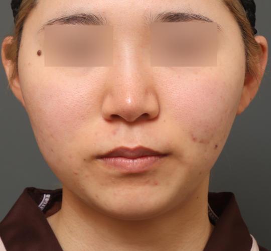 20代女性の二重アゴ筋肉縛り（ペリカン手術） Before 症例写真