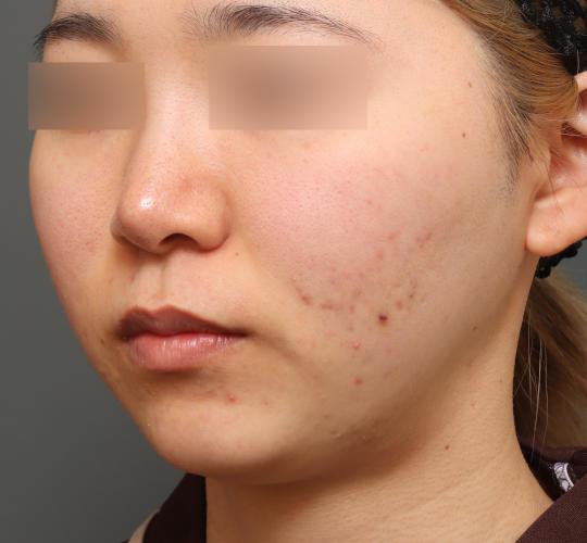 20代女性の二重アゴ筋肉縛り（ペリカン手術） Before 症例写真