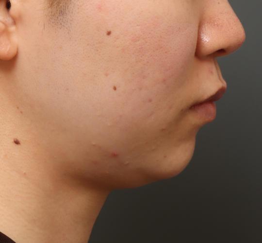 20代女性のエラ・アゴ・小顔 Before 症例写真