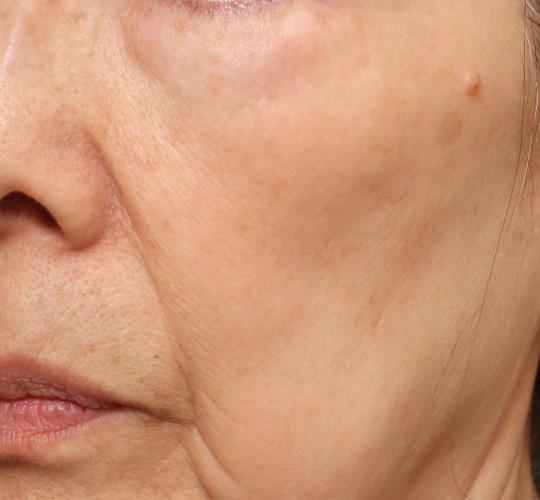 60代女性のシワ・たるみ After 症例写真