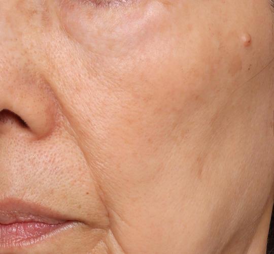 60代女性のシワ・たるみ Before 症例写真