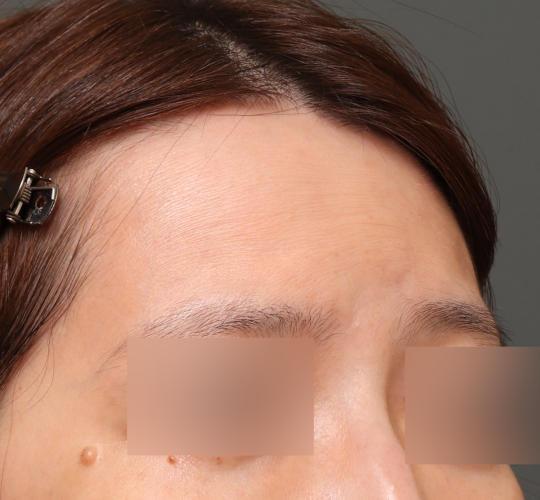 40代女性のスネコス After 症例写真