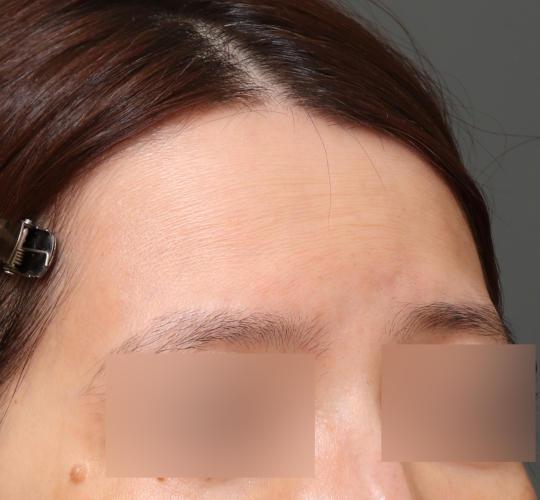 40代女性のスネコス Before 症例写真