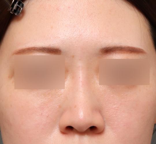 20代女性のヒアルロン酸注射（鼻形成） After 症例写真