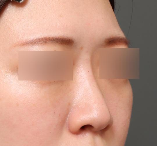 20代女性のヒアルロン酸注射（鼻形成） After 症例写真