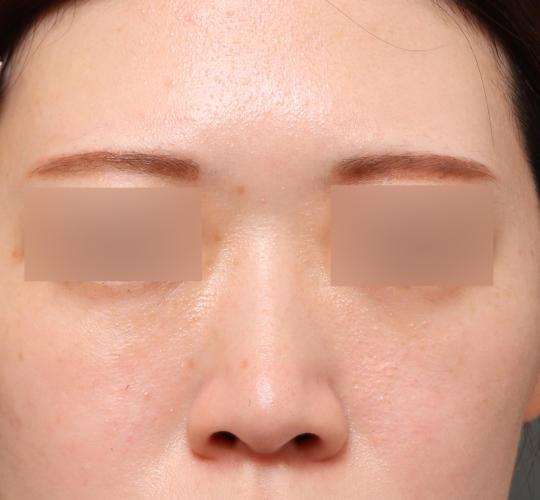 20代女性のヒアルロン酸注射（鼻形成） Before 症例写真