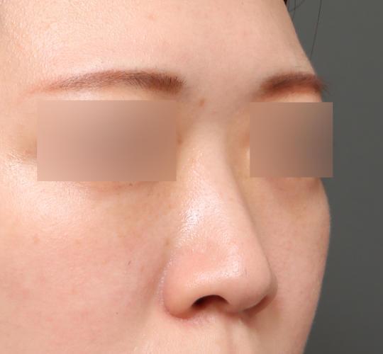 20代女性のヒアルロン酸注射（鼻形成） Before 症例写真