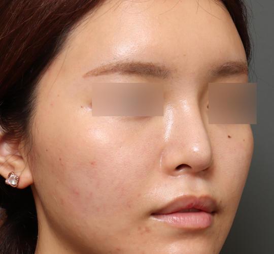 20代女性のシワ・たるみ After 症例写真