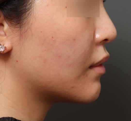 20代女性のヒアルロン酸注射  After 症例写真