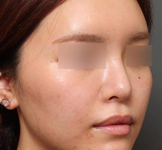 20代女性のシワ・たるみ Before 症例写真