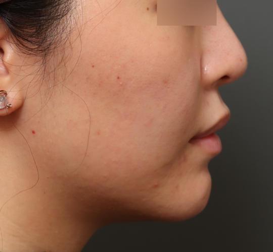 20代女性のヒアルロン酸注射  Before 症例写真