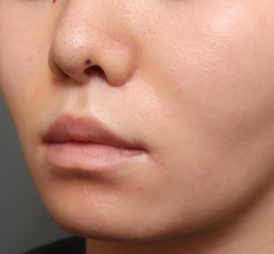 20代女性の人中短縮（リップリフト） After 症例写真