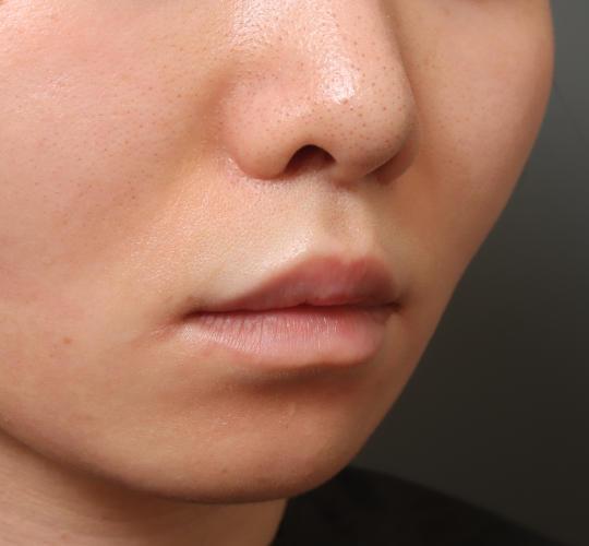 20代女性の人中短縮（リップリフト） After 症例写真