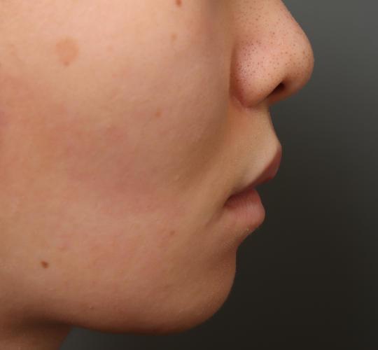 20代女性の人中短縮（リップリフト） After 症例写真