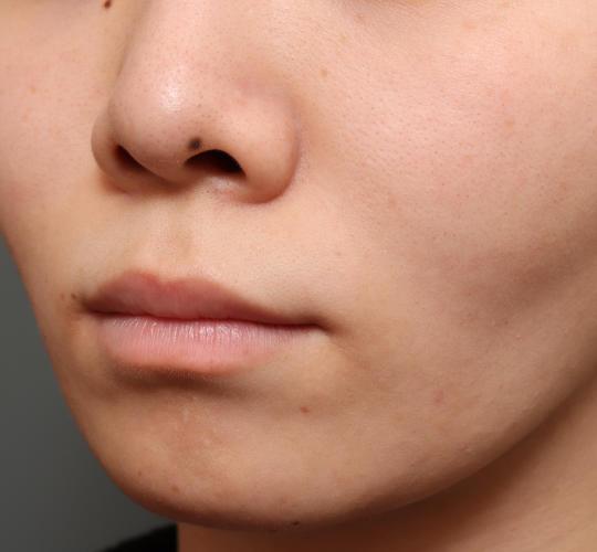 20代女性の人中短縮（リップリフト） Before 症例写真