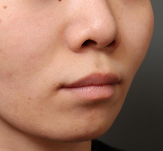 20代女性の人中短縮（リップリフト） Before 症例写真