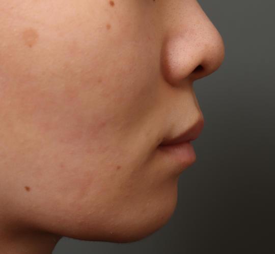 20代女性の人中短縮（リップリフト） Before 症例写真