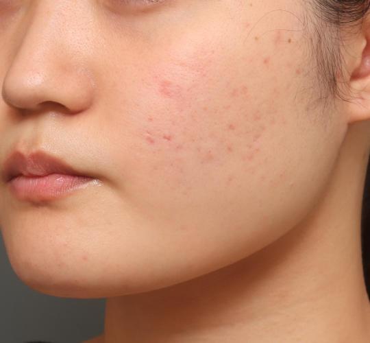 20代女性の顔の脂肪吸引  After 症例写真