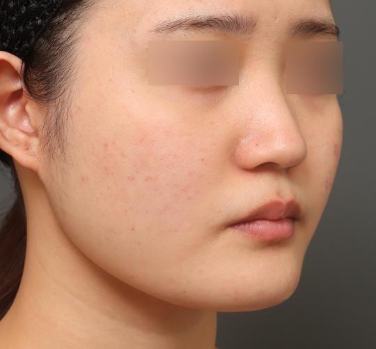 20代女性の顔の脂肪吸引  After 症例写真