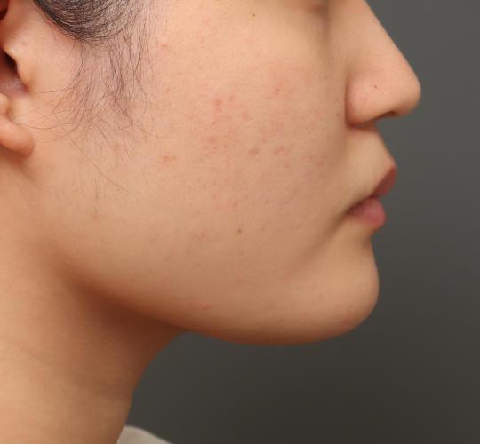 20代女性の顔の脂肪吸引 After 症例写真