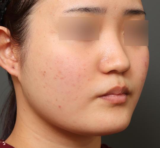 20代女性の顔の脂肪吸引  Before 症例写真