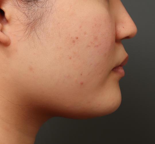 20代女性の顔の脂肪吸引 Before 症例写真