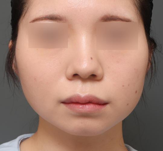 20代女性の顔の脂肪吸引  After 症例写真