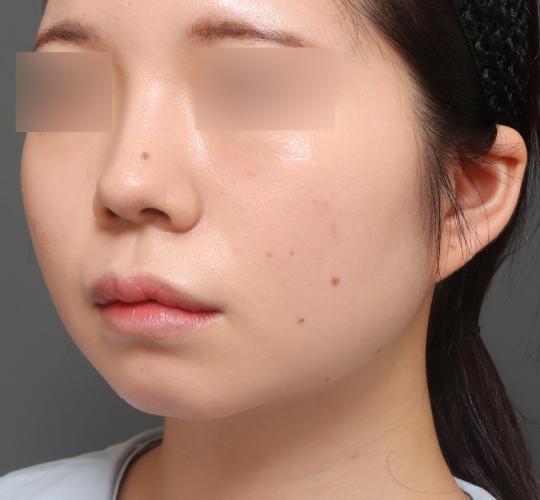 20代女性の顔の脂肪吸引  After 症例写真