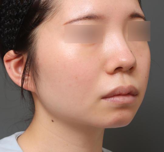 20代女性の顔の脂肪吸引  After 症例写真