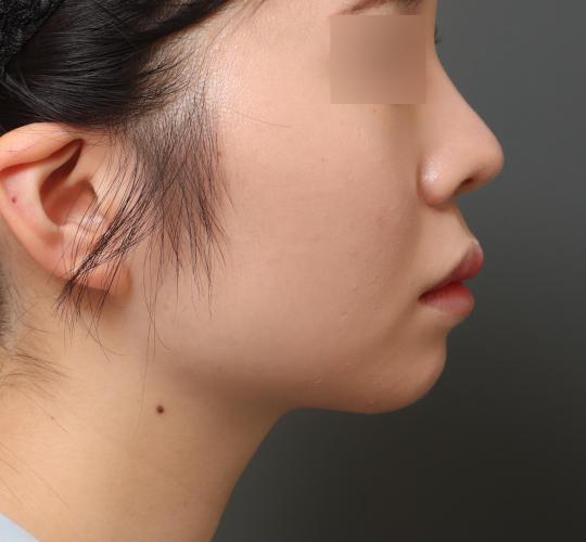 20代女性の顔の脂肪吸引  After 症例写真