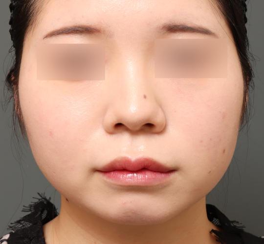 20代女性の顔の脂肪吸引  Before 症例写真