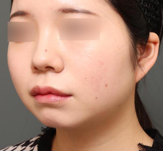 20代女性の顔の脂肪吸引  Before 症例写真