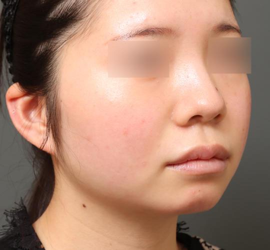 20代女性の顔の脂肪吸引  Before 症例写真
