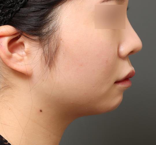 20代女性の顔の脂肪吸引  Before 症例写真