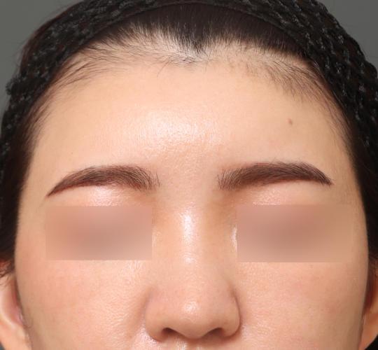 20代女性のヒアルロン酸注射（額） After 症例写真