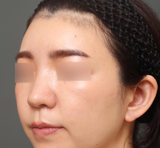 20代女性のヒアルロン酸注射（額） After 症例写真