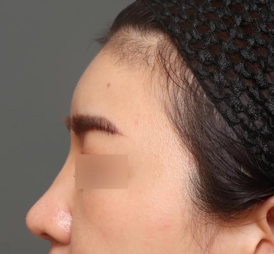 20代女性のヒアルロン酸注射（額） After 症例写真