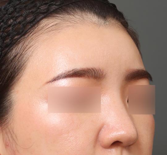 20代女性のヒアルロン酸注射（額） After 症例写真