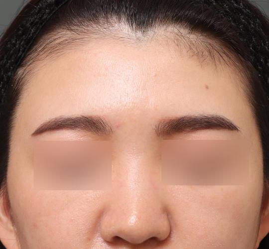 20代女性のヒアルロン酸注射（額） Before 症例写真