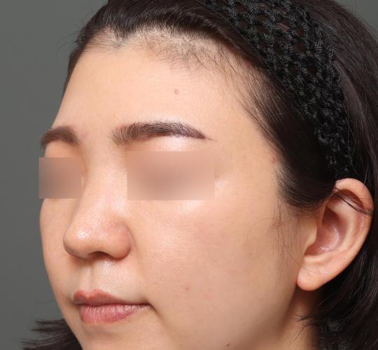 20代女性のヒアルロン酸注射（額） Before 症例写真