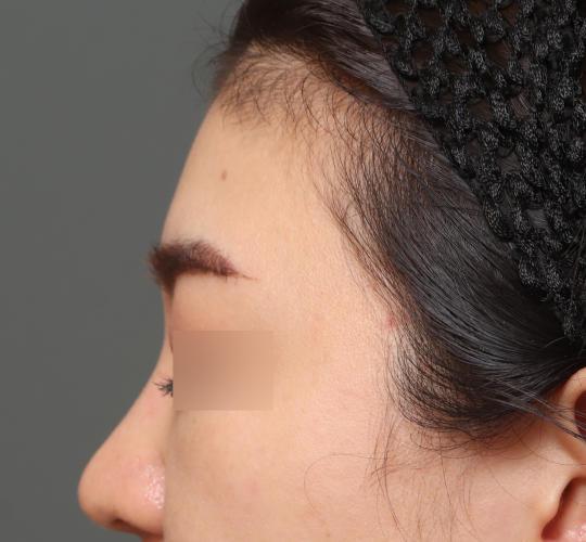 20代女性のヒアルロン酸注射（額） Before 症例写真