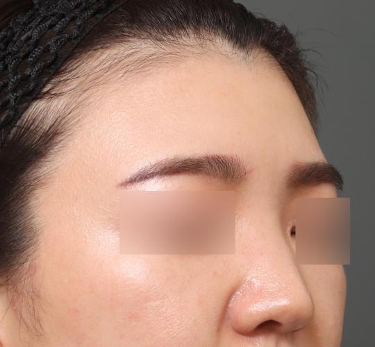 20代女性のヒアルロン酸注射（額） Before 症例写真