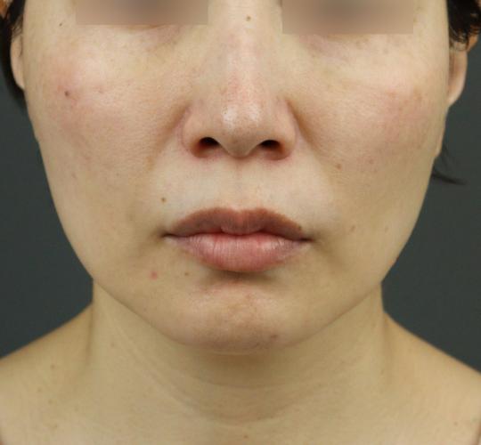 40代女性のグロウHIFUセレクトプラス After 症例写真