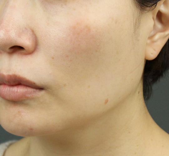 40代女性のヒアルロン酸注射（目の下） After 症例写真