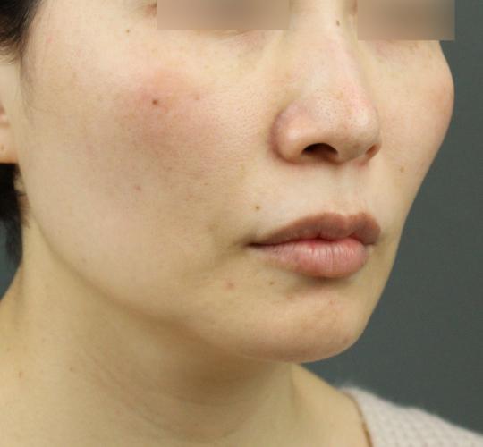 40代女性のグロウHIFUセレクトプラス After 症例写真