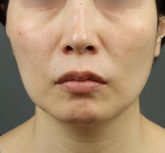 40代女性のグロウHIFUセレクトプラス Before 症例写真