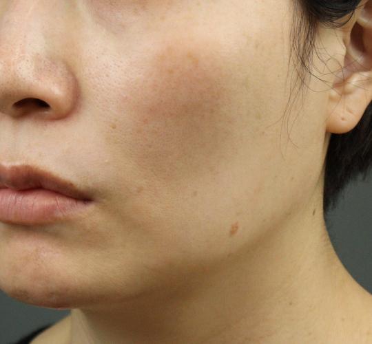 40代女性のヒアルロン酸注射（目の下） Before 症例写真