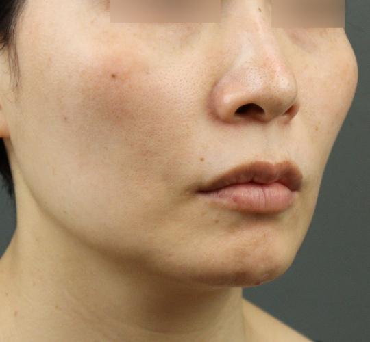 40代女性のグロウHIFUセレクトプラス Before 症例写真