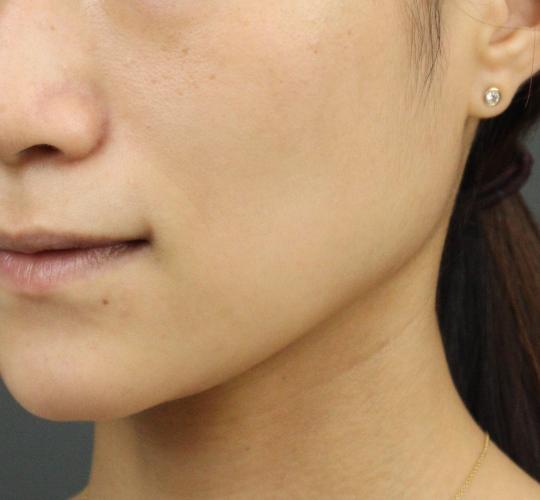 20代女性のグロウHIFUセレクトプラス After 症例写真