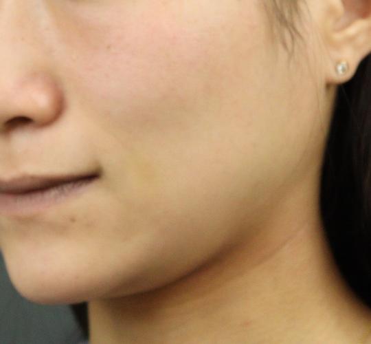 20代女性のグロウHIFUセレクトプラス Before 症例写真